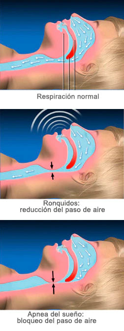 DormiZen™ – Placa 3 en 1 contra Bruxismo, Apnea y Ronquido
